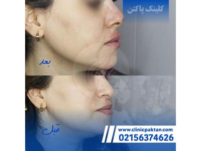 خدمات تزریق ژل-بهترین  و مجهزترین کلینیک لیزر و زیبایی در اسلامشهر 