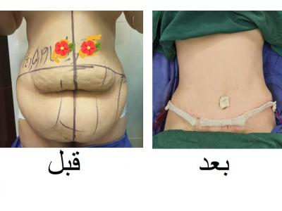 بوتاکس-دکتر محمد گنجه جراح چاقی و پلاستیک ، جراحی کولورکتال و لاپاراسکوپی و بوتاکس معده