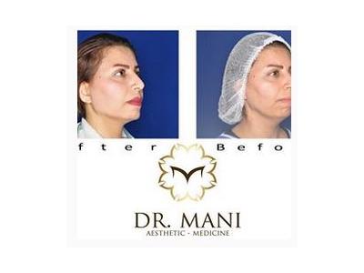 لیفت پشت پلک چشم-دکتر مانی جمالی متخصص پوست و مو   در نیاوران 